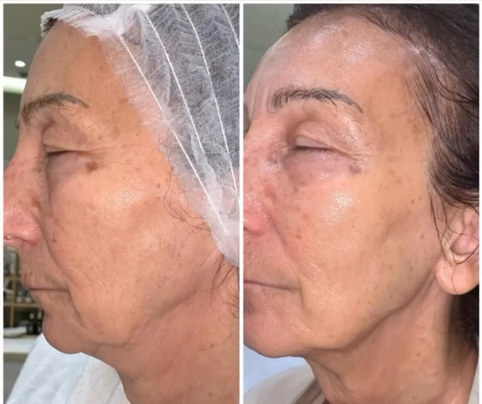 Before and after result