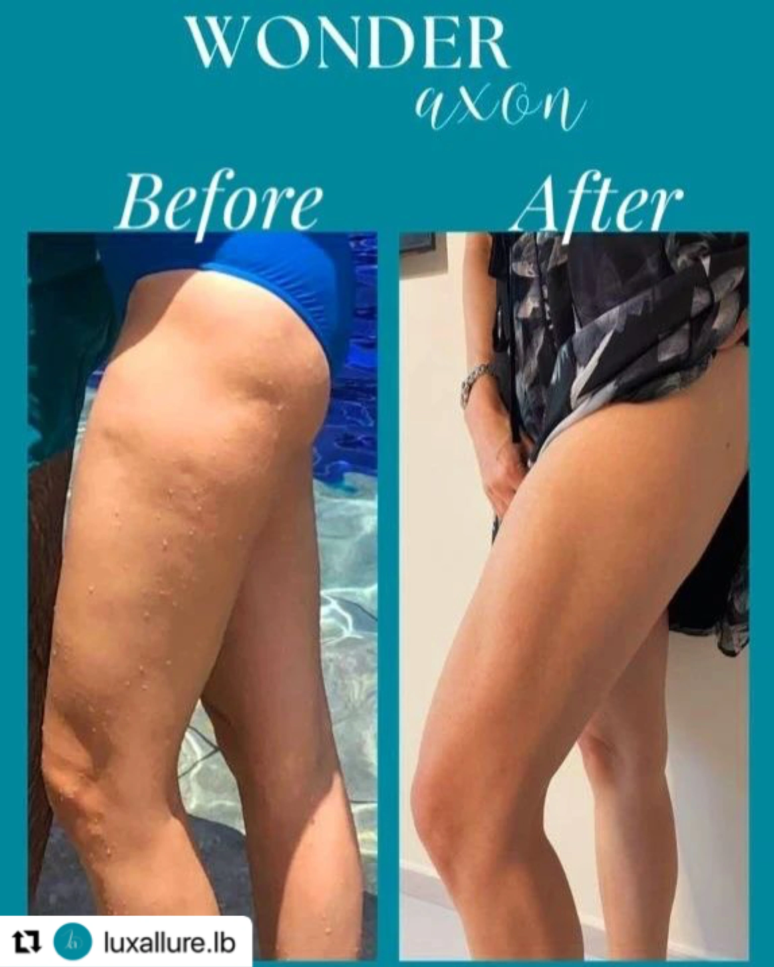 Before and after body contour result