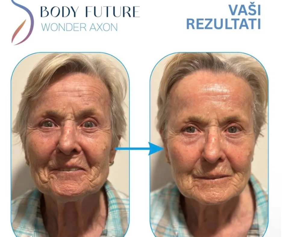 Before and after result