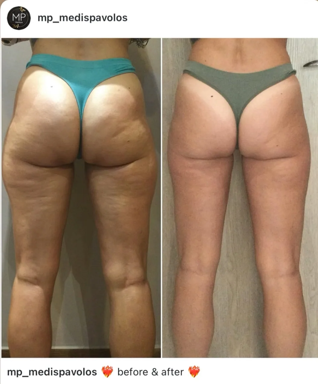 Before and after body contour result