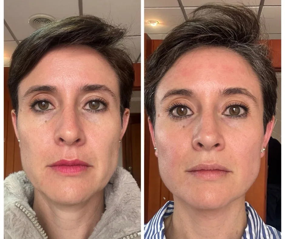 Before and after result