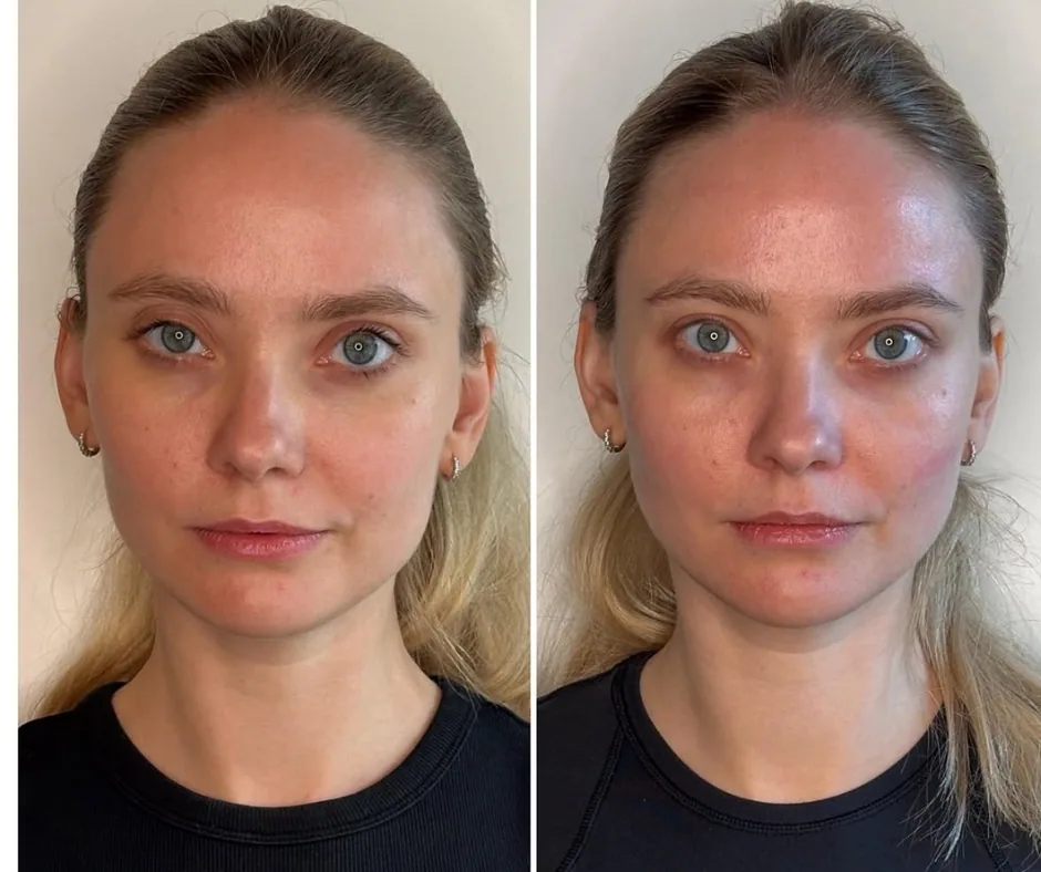 Before and after result
