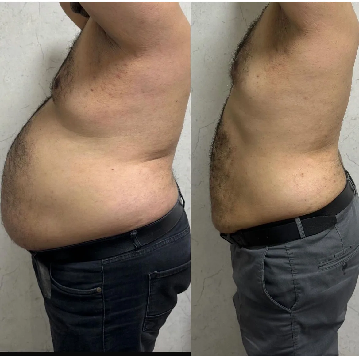 Before and after body contour result