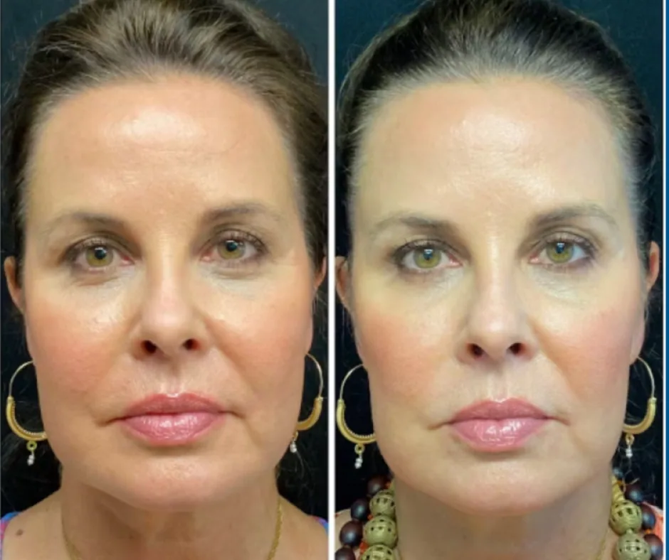 Before and after result