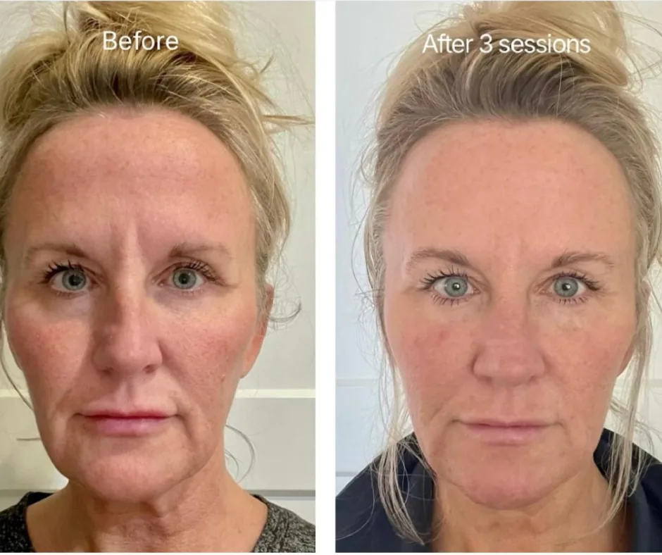 Before and after result