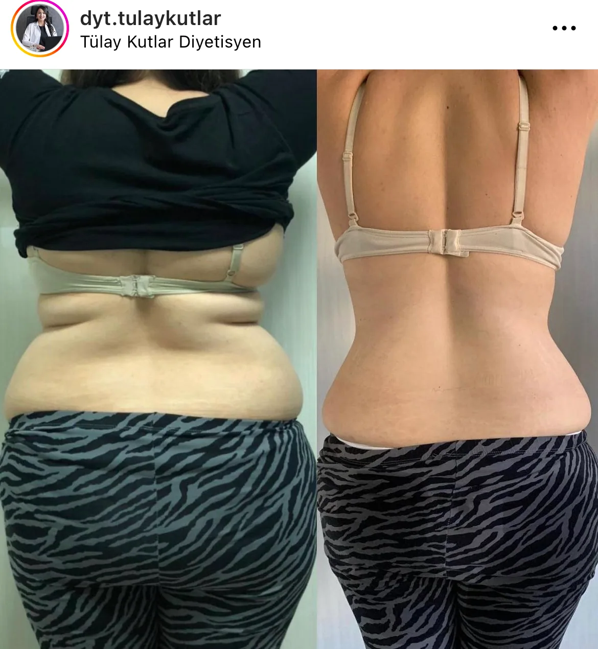 Before and after body contour result