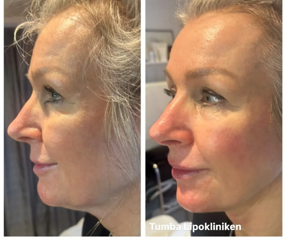 Before and after result