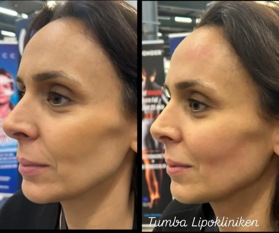 Before and after result